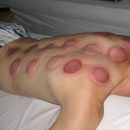 aftercupping